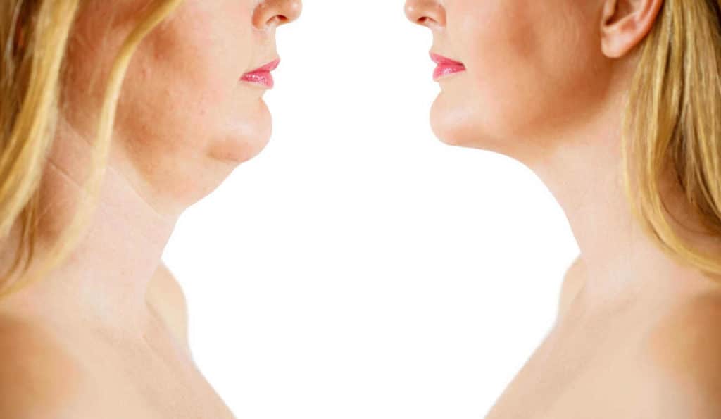 Double Chin treatment Borehamwood before and after results