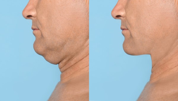 Which Non-Surgical Treatments Work Best for Jowls and Loose Skin Borehamwood?