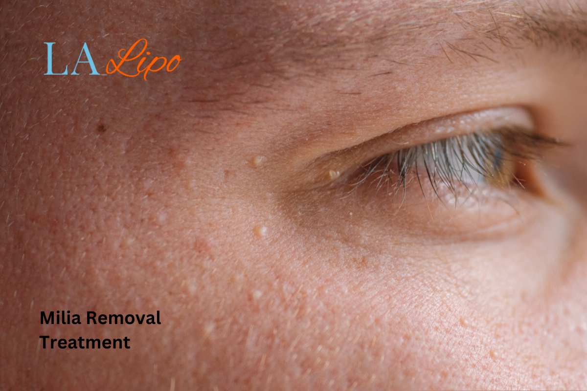 Cryopen Milia Removal: Is It the Easiest and Safest Option Borehamwood?
