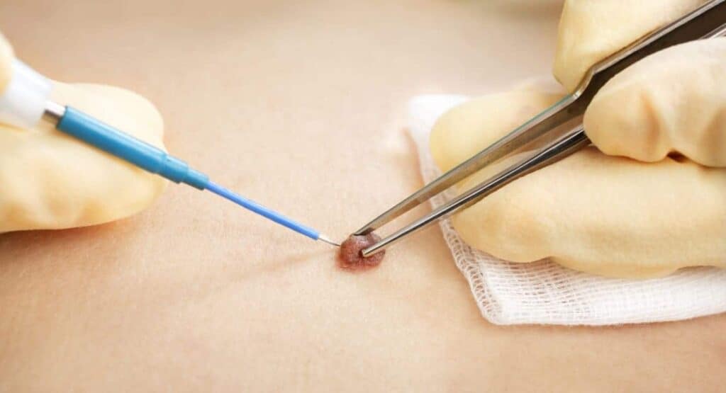 CryoPen