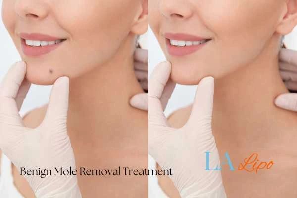 Before-and-after results following benign mole-removal treatment Borehamwood