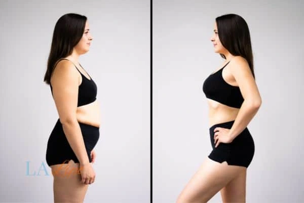 image of woman before and after results of LA-EMS Body Sculpting Borehamwood to help treat Diastasis recti