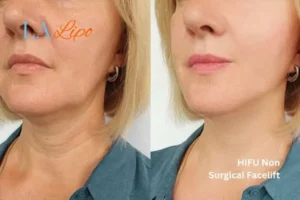 hi-fu for wrinkles Borehamwood before and after results