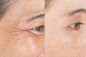 Before and after results of woman - HI-fu wrinkles reduction treatment Borehamwood