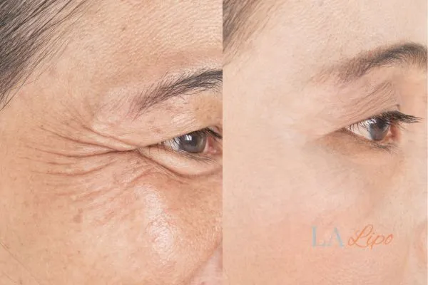 Before and after results of woman - HI-fu wrinkles reduction treatment Borehamwood