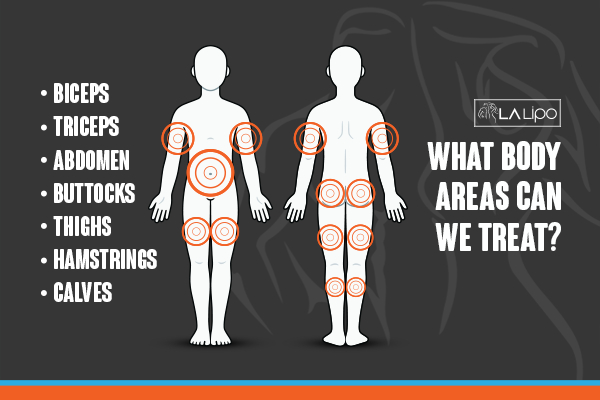 Graphic to show areas you can have LA-EMS Body Sculpting Borehamwood treatment.