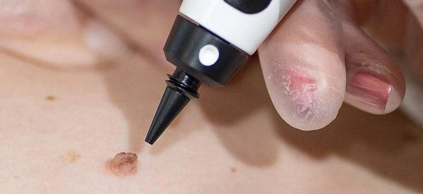 skin tag removal using cryopen Borehamwood