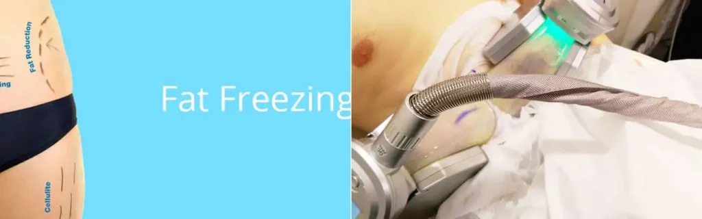 Fat freezing Borehamwood on multiple areas of the body