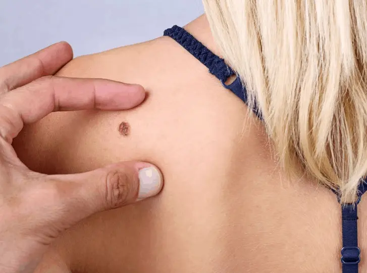 woman having mole removal Borehamwood consultation before treatment.