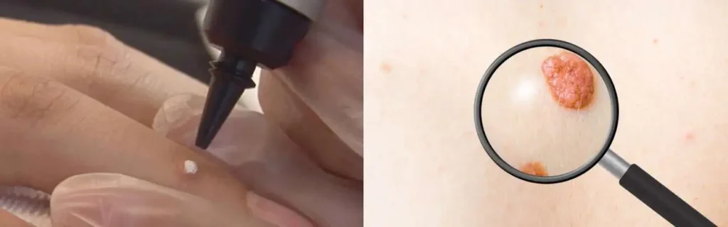 Cryopen for mole removal Borehamwood - speak to our team today!