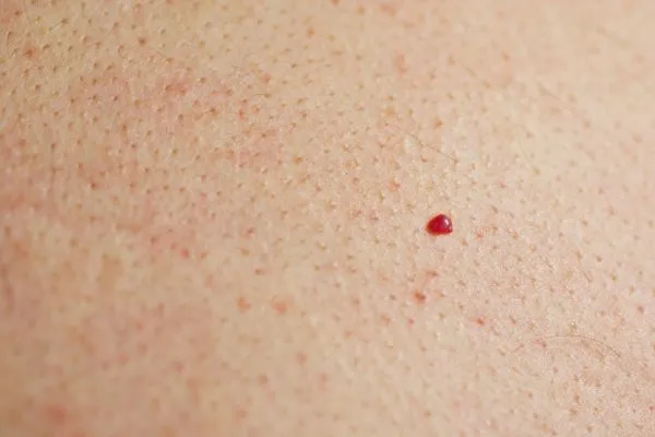 close up of a cherry angioma Borehamwood