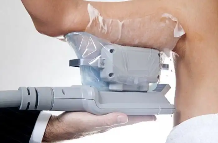 Picture of fat freezing Borehamwood on the upper arms.