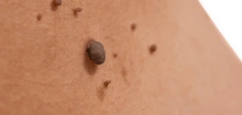 image of a skin tag Borehamwood