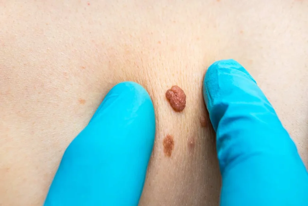 Consultant examining a skin tag Borehamwood