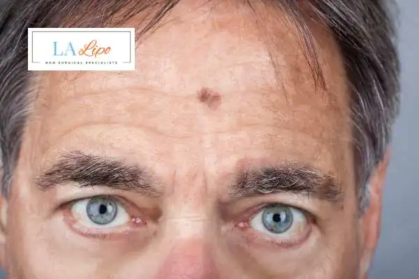 Solar Lentigo Removal Borehamwood image of man with mark on his forehead