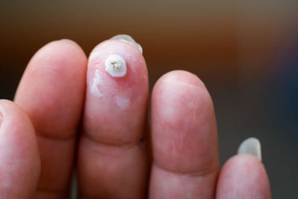 wart on person finger - cryotherapy to treat from LA LIPO Borehamwood