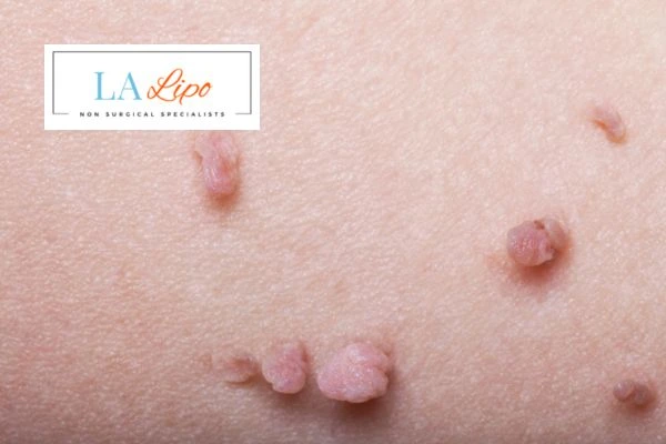Does cryopen skin tag removal Borehamwood hurt? Find out now call our team today!