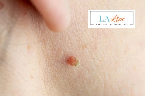 Book skin tag removal Borehamwood today speak to our team now!
