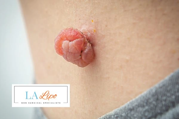 Interested in skin tag removal Borehamwood? Concerned about the pain? Find out more today!