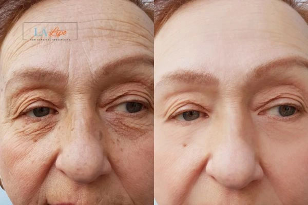 The powerful benefits of Morpheus8 Treatment Borehamwood - Call Our team today!