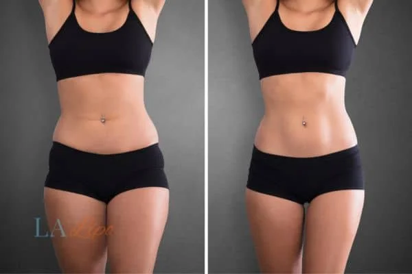 before and after results of non-surgical treatment to help a woman's body image and mental health Borehamwood