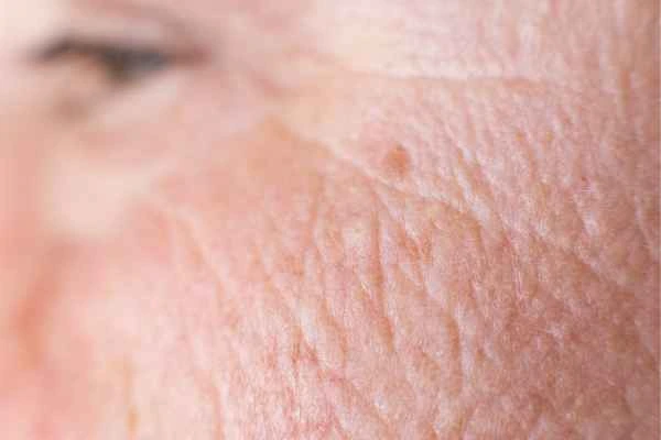 close up picture of a woman's face showing an age spot Borehamwood