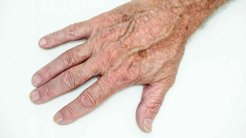 Male hand showing age spot Borehamwood