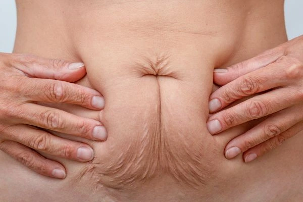 Image of a woman's stomach with loose skin - example of skin tightening Borehamwood options